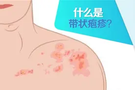 什么是带状疱疹？如何预防？一文了解图片