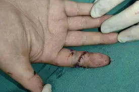 23岁小伙手指被车门旋转“斩”断，医生精雕细琢90分钟让断指“复活”图片