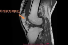 甩腿缓解腿痛，老人用力过猛将膝盖“甩”骨折图片