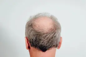 秃顶正在靠近，这些人小心了！这4个方法能拯救你的头发！图片