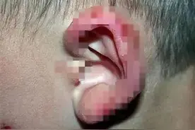 10岁男孩抓耳挠腮致溃烂！医生：这种早春高发疾病要小心！图片