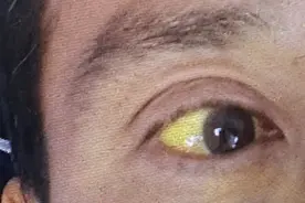 养猪农户感染了这种病引发肝衰竭！这些人群一定警惕起来图片