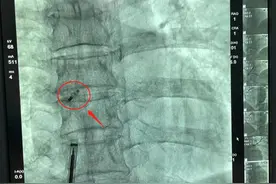 头痛头晕竟是心脏里漏了个洞，医生一次手术解决两个问题图片