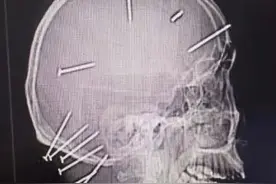 男子精神病发作将9枚钢钉钉入脑中，医生4小时手术全部取出助其脱险图片