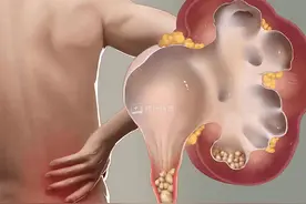 尿路结石患者饮食攻略图片