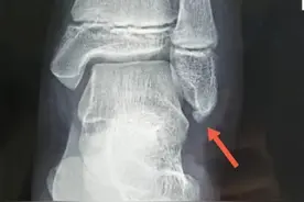 12岁男孩半年崴脚五六次，骨折了！这事很多人都做错了图片