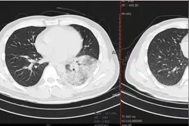 西南医院接诊一例“鹦鹉热”患者 专家提醒：接触禽类后要及时洗手图片
