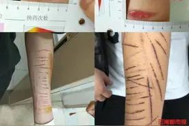 孩子身上有“莫名”伤痕？警惕“非自杀性自伤”行为图片