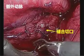 小创口解决大痛苦！普陀人民医院实施腹腔镜下输尿管切开取石术图片