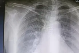 骨折愈合后取钢板，回家忙着干活导致二次骨折图片