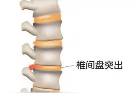腰疼！我是不是腰间盘突出了？图片