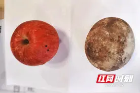 结石比苹果大！湘雅常德医院成功为患者取出巨大膀胱结石图片