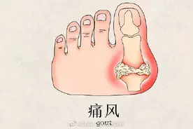 痛风发作有什么症状？图片