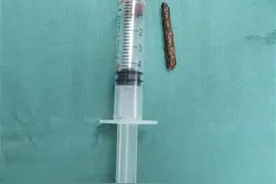 木棍扎进手心“跑”到手腕，十堰人医专家给男童挑“刺”图片