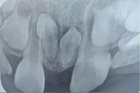 哈市一男孩牙列不齐，拍片发现多生牙玩“潜伏”……图片