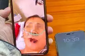 62岁阿姨“卷”身材，付惨痛代价！半年了还躺在医院，皮肤被剥掉一圈……图片