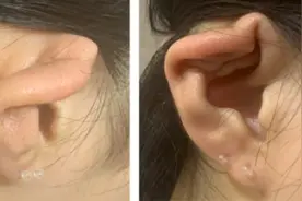 15岁女孩打耳洞导致软骨坏死耳畸形，上海医生圈出打耳洞“危险部位”图片