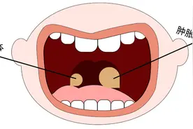 【特色疗法】小儿扁桃体炎不发愁，点刺放血有妙招！图片
