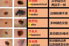 身上这种痣，要不要点？图片