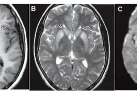 14岁男孩，颅脑MRI惊现“熊猫脸”，竟是这个病……图片