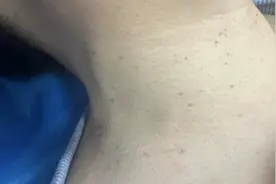 脖子上长“金针菇”，真相是HPV感染？图片