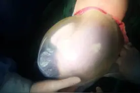 裹膜出生的“水晶宝宝”，州医院产科又增新技术图片