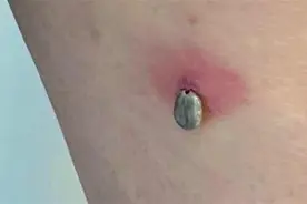 湖北省疾控中心专家提醒：蜱虫叮咬进入高发期，严重可危及生命！图片