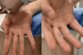 手出汗严重怎么办？松山医院胸外科助力重度手汗症少女顺利止汗图片