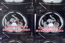 男子出现咖啡色血尿不痛未理，直至剧痛就医才知结石堵住输尿管图片