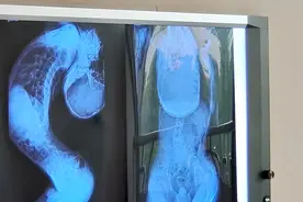 山东00后“折叠男孩”治疗方案确定，北大医院：需至少5次手术图片