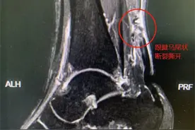 踢球时一声脆响，跟腱断了！图片