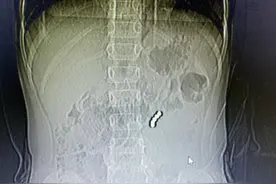 6岁女孩误吞磁力珠，医生：两处肠壁已经穿孔图片