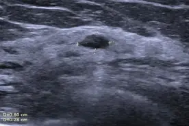 乳腺小结节是“良”还是“恶”？超声引导下，钩针定位，精准诊断图片