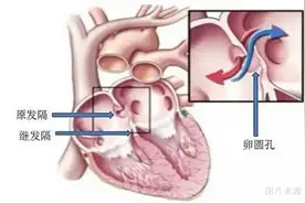 青年人不明原因脑梗死 警惕“卵圆孔未闭”图片
