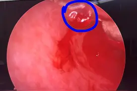 男子无故鼻血不止，竟是高血压“冲破”鼻部血管图片