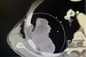 胸口巨大肿瘤，多家医院不接收，看华西胸外科陈龙奇团队切除肿瘤、重建胸壁！图片