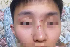 株洲一男生中考前两天被同桌打骨折，还遭对方家长嘲笑？当地警方已介入图片