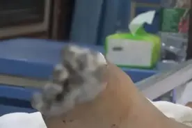 17岁女孩充电时用iPhone被电击，内脏受损，脚趾被烧焦面临截肢图片