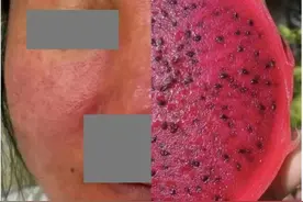 女子脸烂成“火龙果”，医生都说少见！罪魁祸首就在家里图片