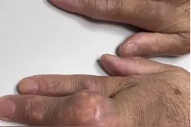 爱吃海鲜配啤酒 福州一男子痛风发作手上长满“石疙瘩”图片