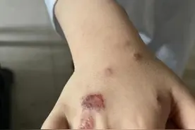 5岁男孩全身长满红斑，一抓就烂……妈妈急哭：天一热就加重图片