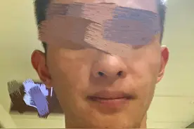 健康小站|跑步后身上起红疹，盛夏运动小心胆碱能性荨麻疹！图片