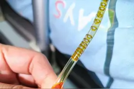 头皮发麻！南宁一女子体内惊现大量“瓜子”活虫，只因家人爱吃鱼生图片