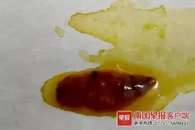 女子胸腹部间歇性疼痛，体内竟爬出瓜子大小活虫！图片