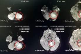 心脏上这个小孔，1/4人不会闭合，18岁小伙因此脑梗图片