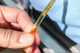 好可怕！广西一女子体内查出大量“瓜子”活虫，全因为……图片