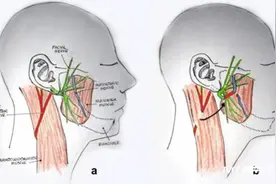 半侧脸歪斜、嘴角流涎可能不仅是面瘫，还可能是腮腺癌图片