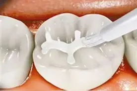 科普知识 | 什么是涂氟和窝沟封闭？图片