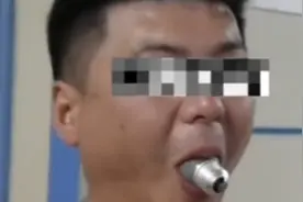 男子因好奇吞灯泡卡在口中，蒙面跑到消防队求助，医生用扩张钳成功拔出视频封面