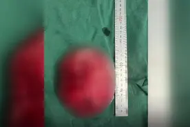 浙江一13岁女孩胸部变大，以为是发育，去医院一查，没想到是纤维瘤图片